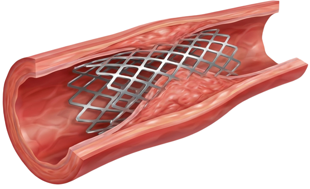 Angiographic review of a failed prior PCI before redo intervention planning